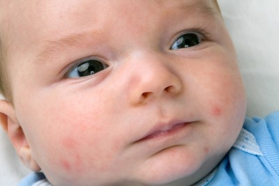Eczema in Infants